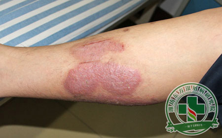 如何減輕膿皰型銀屑病患者的痛苦