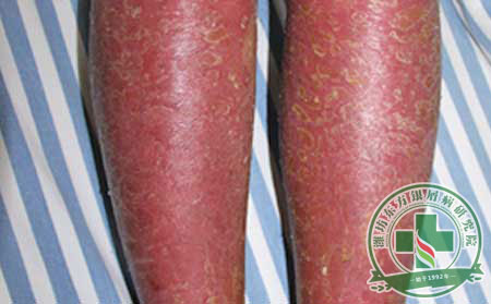 如何辨別自己是否患有紅皮病型銀屑病