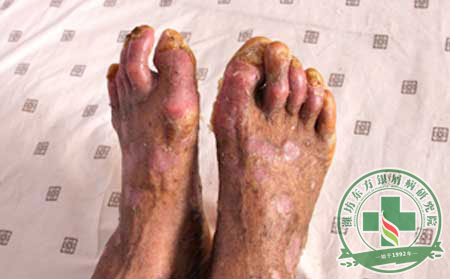 如何確定病患得了膿皰型銀屑病