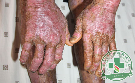 怎樣確認(rèn)患者患有關(guān)節(jié)型銀屑病