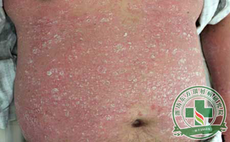 尋常型銀屑病的皮損表現(xiàn)形式