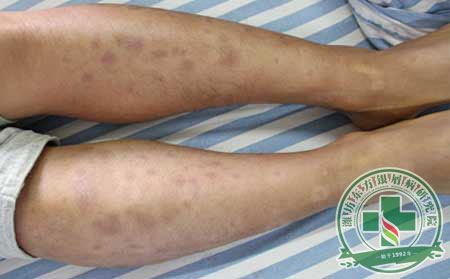 尋常型銀屑病的癥狀及預防