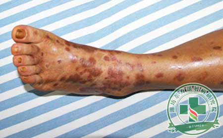 膿皰型銀屑病的發病因素