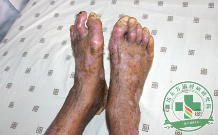 關節型銀屑病的危害起因