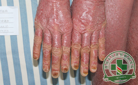 關節病性銀屑病