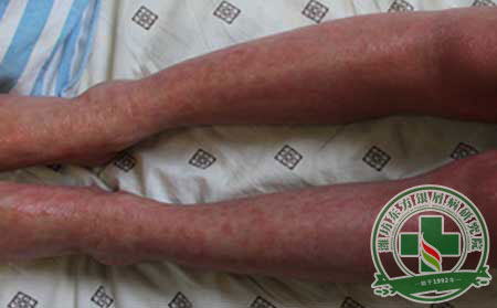 紅皮病型銀屑病