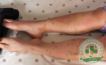 銀屑病冬季預防