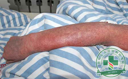 銀屑病護(hù)理