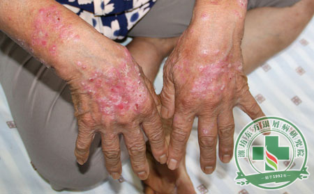 銀屑病病因