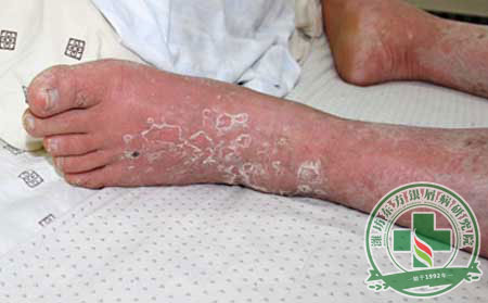 密切防范誘發銀屑病的原因