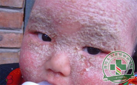 面部牛皮癬病因  