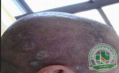 15.頭部銀屑病患者日常護(hù)理