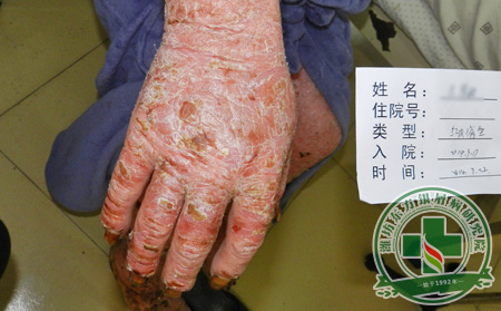 關節型銀屑病對關節的危害是什么