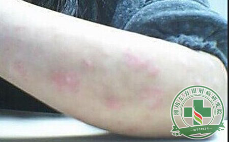 銀屑病消退期癥狀表現