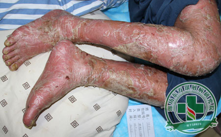 膿皰型銀屑病的三種類型