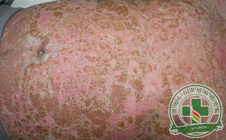 幾點(diǎn)誘發(fā)銀屑病的因素