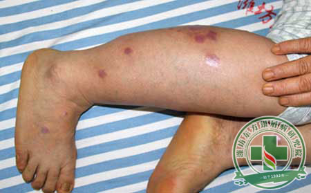 尋常型銀屑病患者要注意些什么