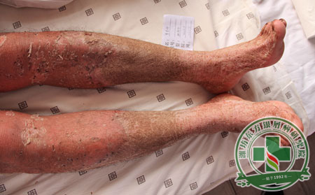 膿皰型銀屑病的病理表現