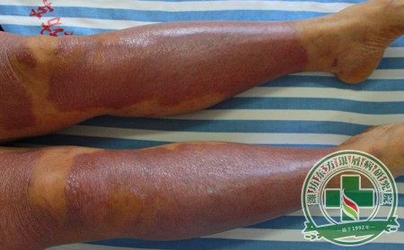 紅皮病型銀屑病