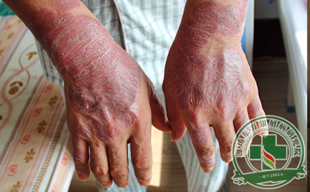 銀屑病患者吃啥可以—濰坊東方銀屑病研究院 