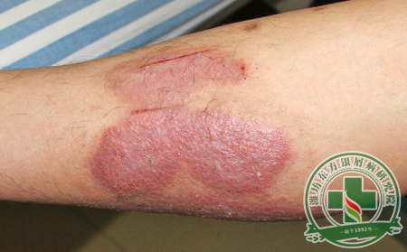 銀屑病真正的病因是什么？  