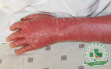 紅皮病型銀屑病