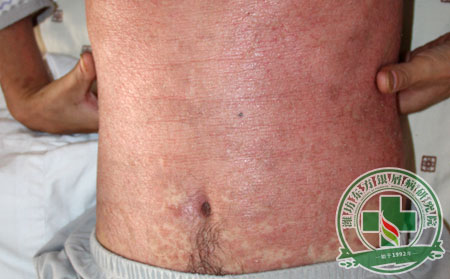 銀屑病護(hù)理