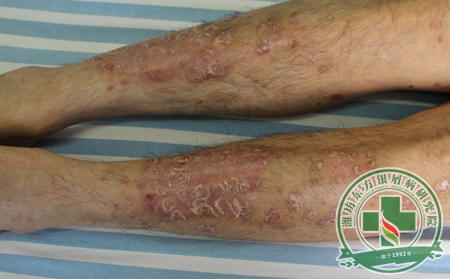 銀屑病誘發因素