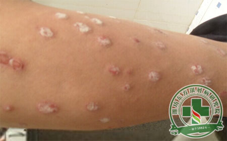 得了銀屑病，患者要注意什么？