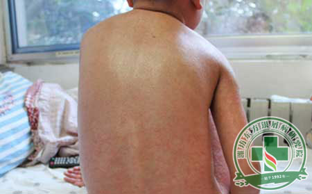 銀屑病歸根究底的三類誘發因素