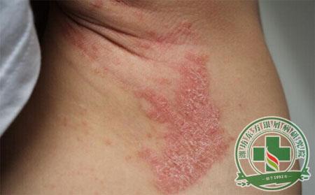 銀屑病復發怎么診斷？