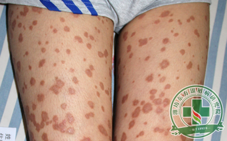 尋常型銀屑病的具體分析
