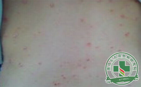 銀屑病發病規律 