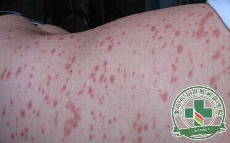 銀屑病與微量元素的關(guān)系 