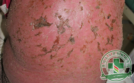 紅皮病型銀屑病