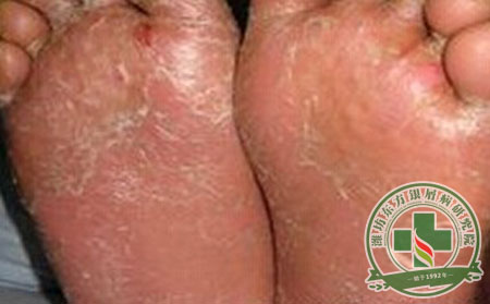 足底銀屑病癢咋整啊？