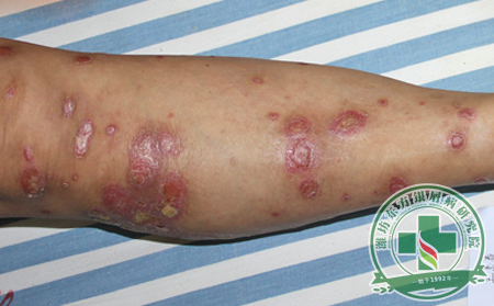 銀屑病護(hù)理