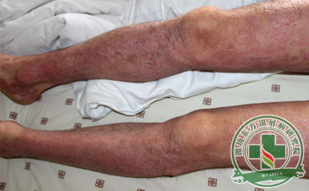 銀屑病護(hù)理