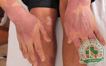 銀屑病護理方法