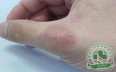 手上牛皮癬該咋治？ 