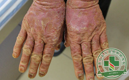 關(guān)節(jié)型銀屑病