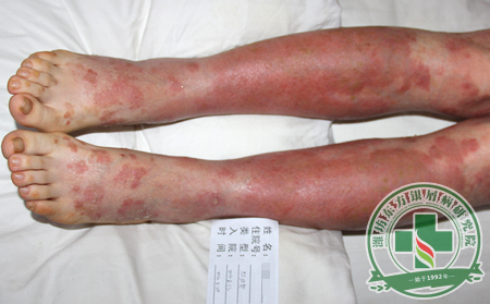 銀屑病治療