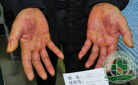 銀屑病的誘因是免疫系統異常？