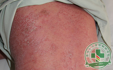 尋常型銀屑病患者要學會基本診斷