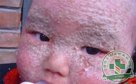 面部銀屑病怎么好的得快？