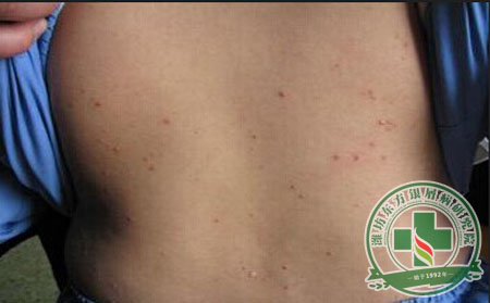 銀屑病患者怎么才能控制病情呢？ 