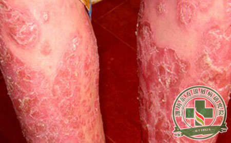 地圖形銀屑病的臨床癥狀表現(xiàn)