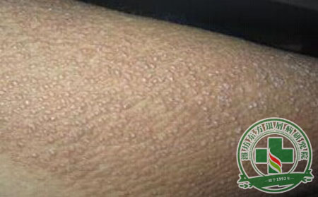 怎么區(qū)分銀屑病和濕疹？