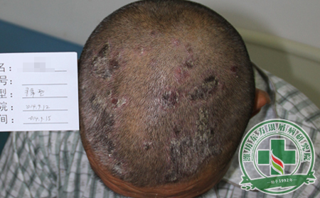 頭部銀屑病