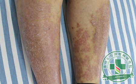 銀屑病預(yù)防